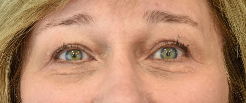 Eyelid Surgery Patient 8 Set 1 After